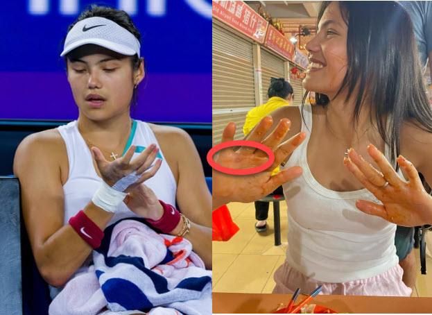 Emma Raducanu Blisters Emma Raducanu Blisters