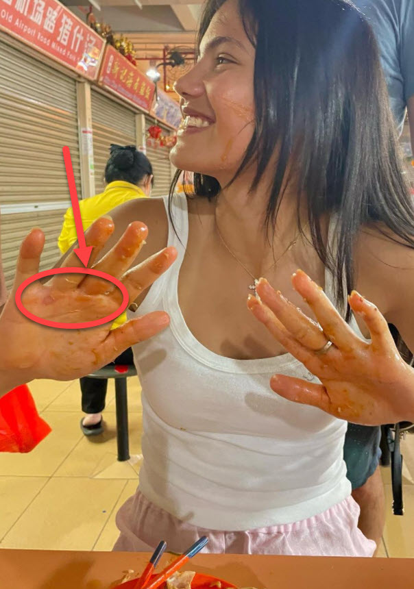 Emma Raducanu Blister Scras